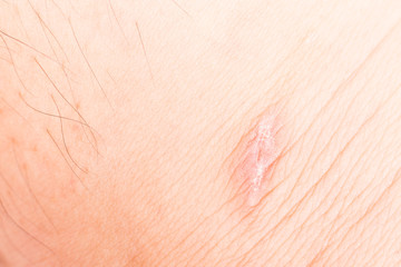 Close up on scar on leg, upon recovery
