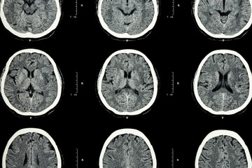 CT scan of brain show normal brain ( Neurological background )CT scan of brain show normal brain ( Neurological background )