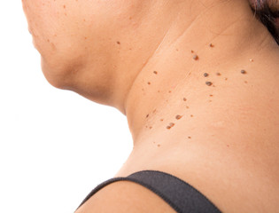 skin of a woman with moles