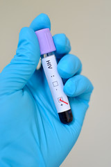 Obraz premium Blood sample with HIV positive