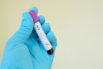 Obraz premium Hepatitis C virus positive