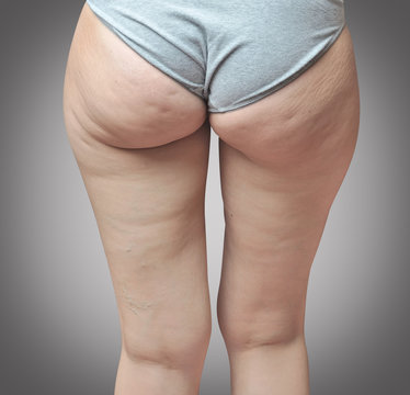Cellulite at woman buttocks.Gray background