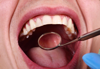 The dentist inserts the swab