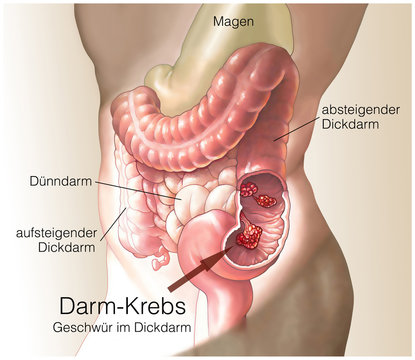 Darmkrebs.Geschw&uuml;r im Dickdarm