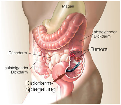 Dickdarm-Spiegelung.Darmkrebs