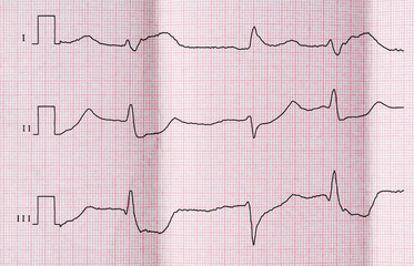 ECG with acute period of myocardial infarction 