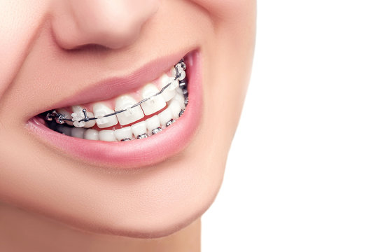 Braces. Orthodontic Treatment. Dental Care Concept. Beautiful WomanHealthy Smile close up. Closeup Ceramic and Metal Brackets on Teeth. Beautiful Female Smile with Braces.