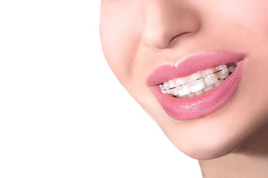 Closeup Ceramic Braces on Teeth. Beautiful Female Smile with Braces. Orthodontic Treatment. Dental care Concept. B.