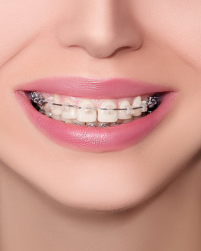 Closeup Ceramic and Metal Braces on Teeth. Beautiful Female Smile with Brackets. Orthodontic Treatment. Front View..