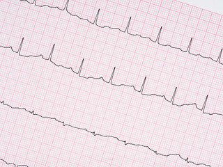 Electrocardiogram, ECG detail.