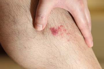 The wound on man's leg