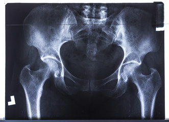 Pelvis x-ray