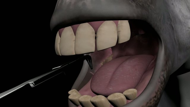 3D medical animation about diseased equine teeth and explaining several (oral) extraction techniques.
Part 4: (Repulsion) buccotomy - pin technique
