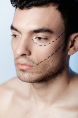 The man on the face is marked with guides before surgery filling wrinkles, crow's feet, injection of hyaluronic acid, plastic operation