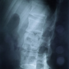 X-ray