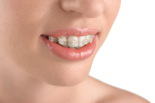 Teeth alignment. Braces. Beautiful woman smiling.