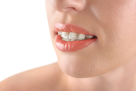 Teeth alignment. Braces. Beautiful woman smiling.