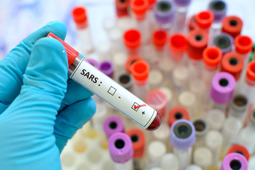 Obraz premium Blood sample with SARS (Severe acute respiratory syndrome) virus positive