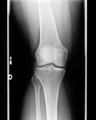 X-ray of knee with Chondromalacia condition stae 1 front view