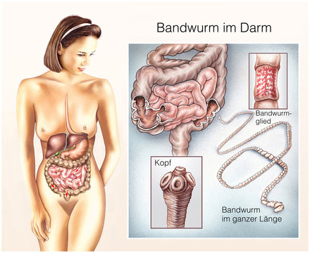 Bandwurm.Erkrankungen im Darm