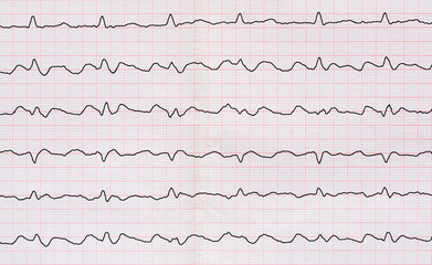 ECG with paroxysm correct form of atrial flutter 