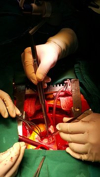 In Operation Mitral Valve Replacement