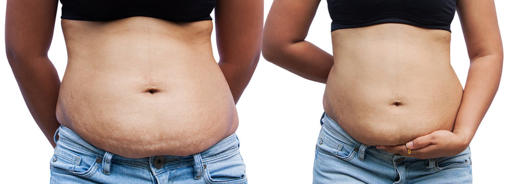 women body fat belly 