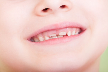 Closeup of child mouth with new teeth growing