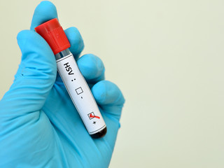 Obraz premium Blood sample with HSV (Herpes Simplex Virus) positive