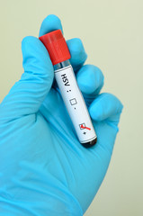 Obraz premium Blood sample with HSV (Herpes Simplex Virus) positive