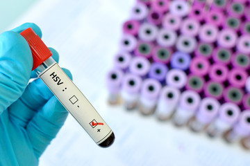 Obraz premium Blood sample with HSV (Herpes Simplex Virus) positive
