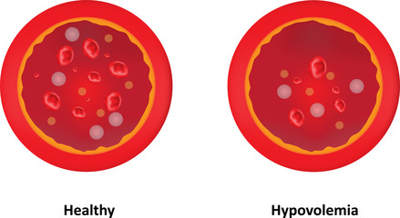 Hypovolemia