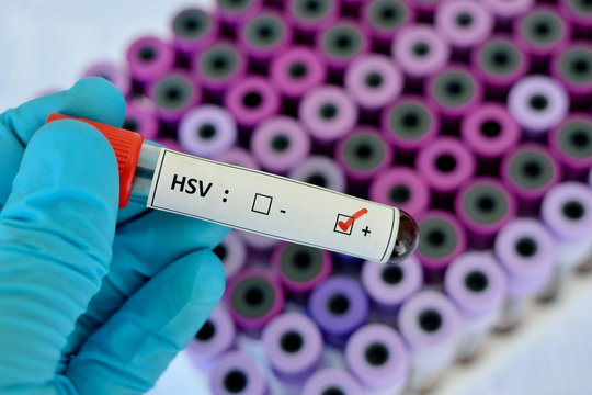 Herpes positive
