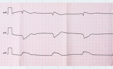 Tape ECG after clinical death and a successful resuscitation