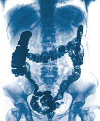 picture of intestinal abdominal xray - obrazy, fototapety, plakaty