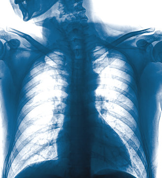 X-Ray Image Of Human Healthy Chest MRI
