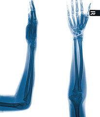 X-ray of both human arms and hands