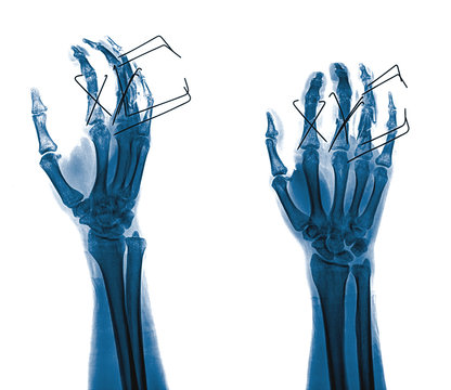 hands x-rays image showing wire fixation ring finger