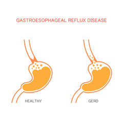 reflux  disease, heartburn, stomach pain, human gastric acid 