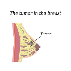 The tumor in the breast. On isolated background. The structure