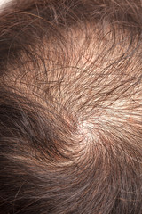 lose one's hair glabrous baldy loss