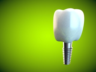 Tooth molar implant Dental Hygiene Dentist 3D green