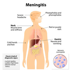 Meningitis