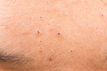 Fototapeta premium Close up on pimples, acne, zit and blackheads on forehead of a teenager
