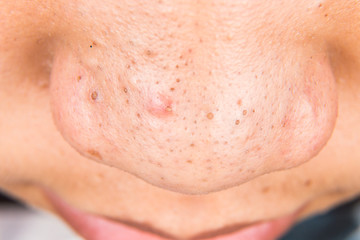 Fototapeta premium Ugly pimples, acne, zit and blackheads on the nose of a teenager