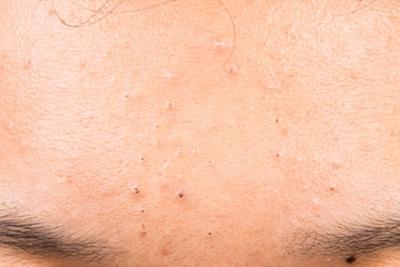 Pimples, acne, zit and blackheads on forehead of a teenager