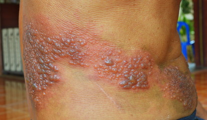 Symptom inflected herpes zoster virus. 