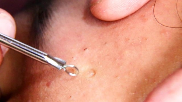 Squeezing pimple blackheads  teenager cheek with pimple popper tool