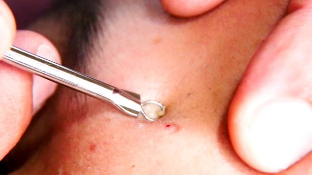 Squeezing pimple blackheads  teenager cheek with pimple popper tool