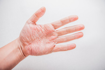 The problem with many people - eczema on hand. Isolated